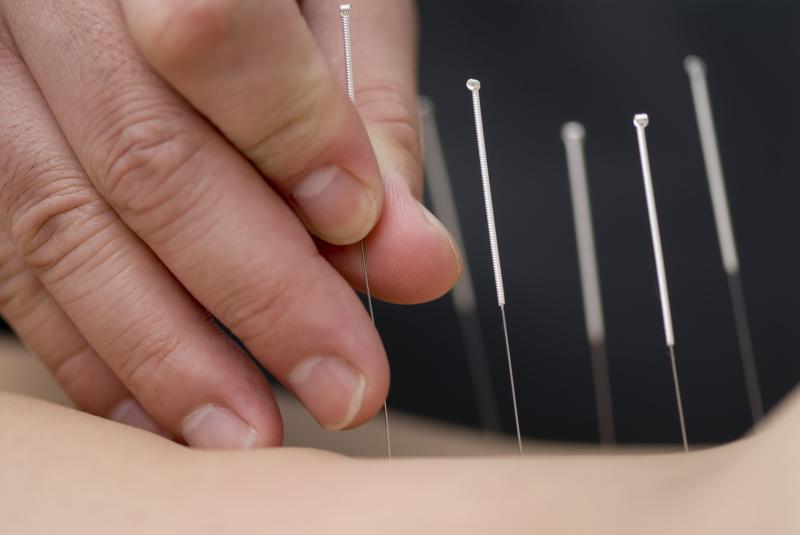 Acupuncture shows promise for poststroke motor aphasia
