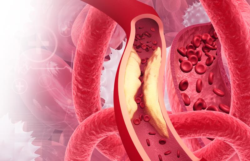 Liraglutide may prevent peripheral artery disease progression in type 2 diabetes