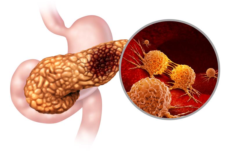 Adjuvant FOLFIRINOX ups survival in pancreatic cancer