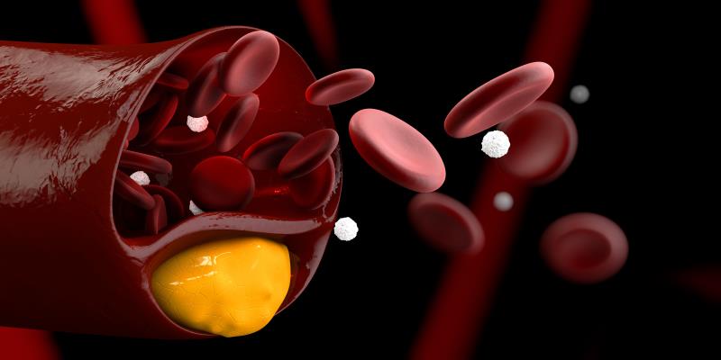 In the phase III REMAIN-2 trial, add-on recaticimab &ndash; a novel, long-acting anti-PCSK9 monoclonal antibody (mAb) &ndash;