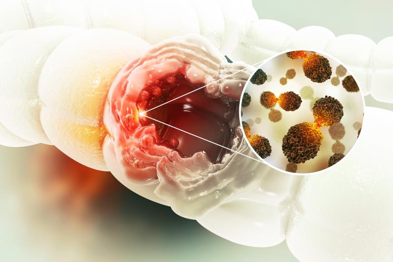 Any upside to frontline mFOLFOXIRI-panitumumab in mCRC?