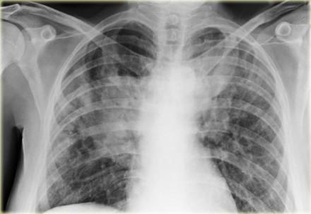 Hint of benefit with antifibrotic treatment seen for interstitial lung disease