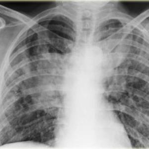 Early RA-ILD raises mortality risk