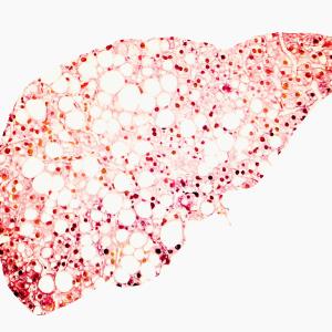 Fasting plasma glucose variability linked to NAFLD risk