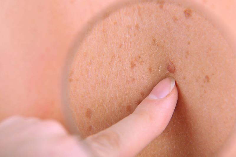 Long-term hydrochlorothiazide use ups risk of skin cancer