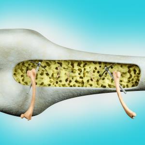 Hormonal contraceptive + TDF-based ART a recipe for bone disaster in young HIV+ women?