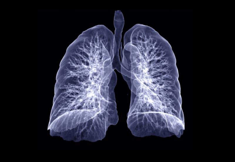Dynamic hyperinflation decreases after EBVs treatment