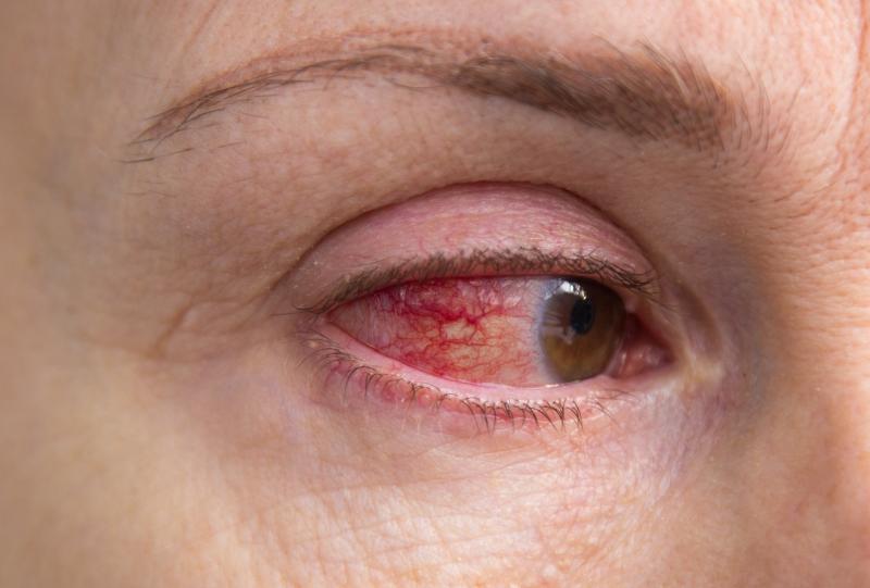 Perfluorohexyloctane eye drops for dry eye disease impresses in phase III trial