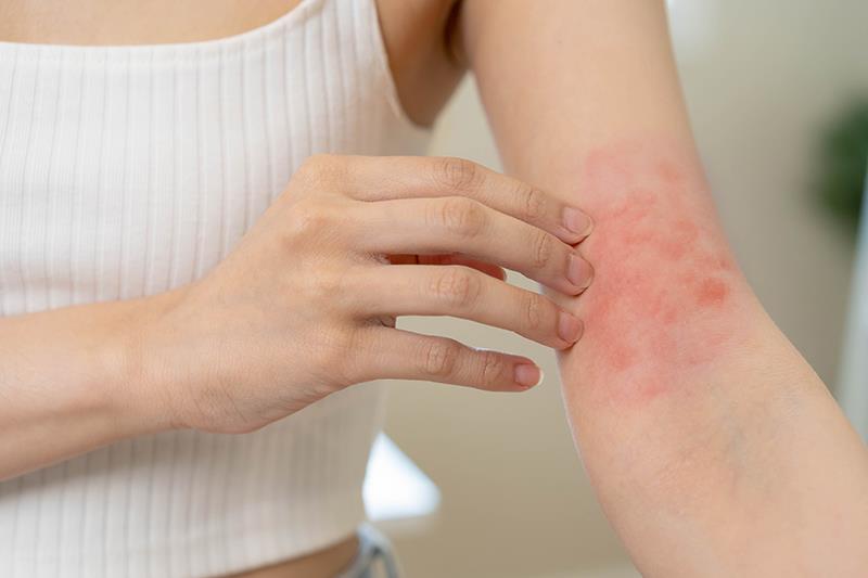 Dupilumab delivers on its promise for Asians with atopic dermatitis