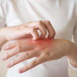 Dupilumab lessens symptoms, betters life quality in atopic hand and foot dermatitis