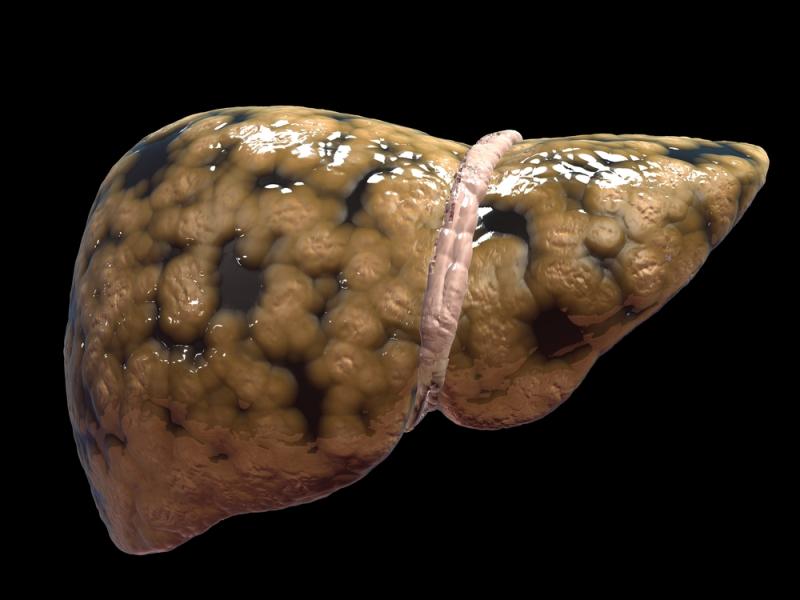 Efinopegdutide beats semaglutide at reducing liver fat in NAFLD patients
