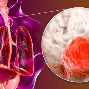 First-line tislelizumab + chemo improves OS in advanced/metastatic ESCC