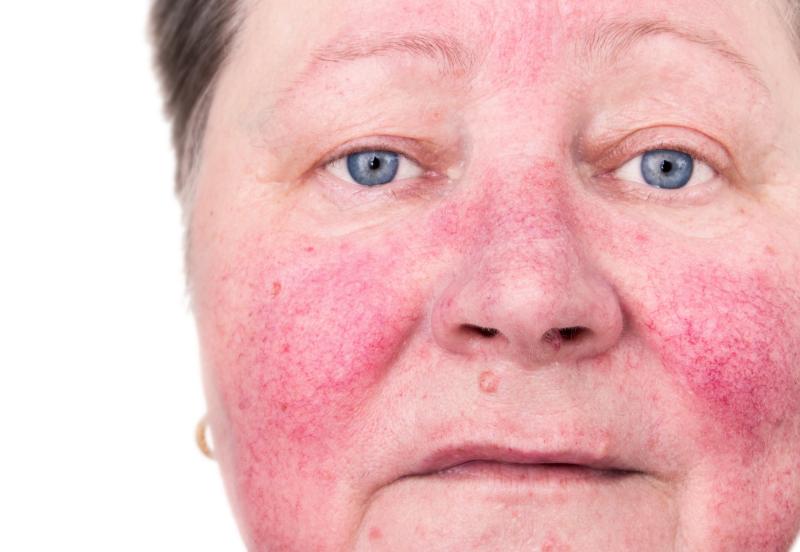 What are the risk factors for severe actinic keratosis?