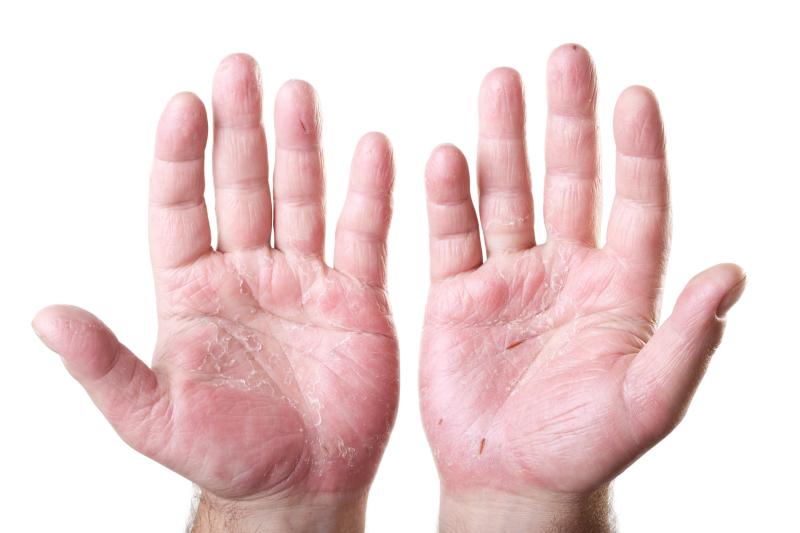Novel lotion formulation helps reduce palm sweating