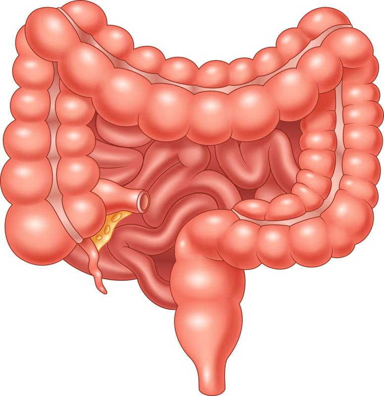 Peroral endoscopic myotomy succeeds in treatment of oesophageal diverticula