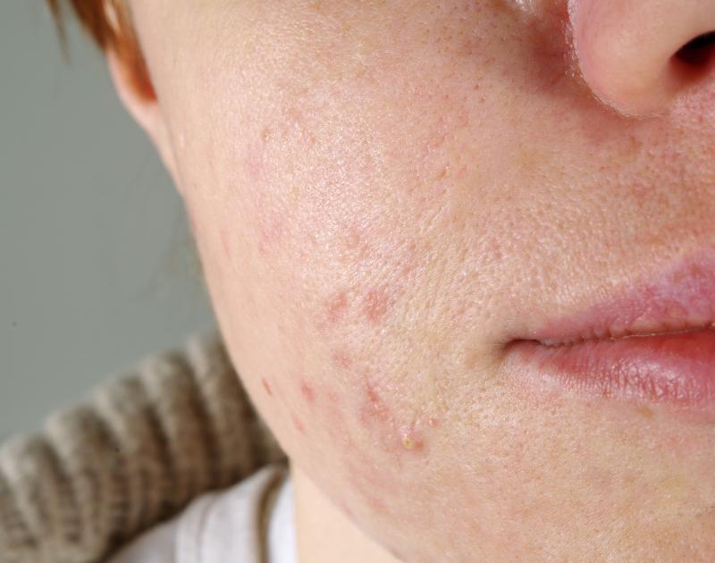 In the treatment of patients with <a href="https://specialty.mims.com/acne%20vulgaris/treatment" target="_blank">acne vulgari