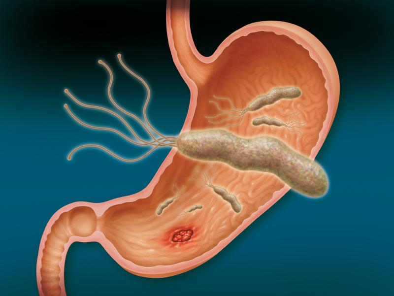 Vonoprazan-based triple therapy knocks out resistant H. pylori infection