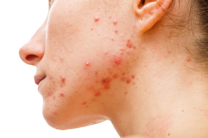 JAK inhibitor use tied to increased odds of acne