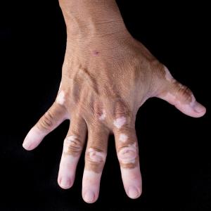 Individuals with vitiligo less prone to melanoma, skin cancer