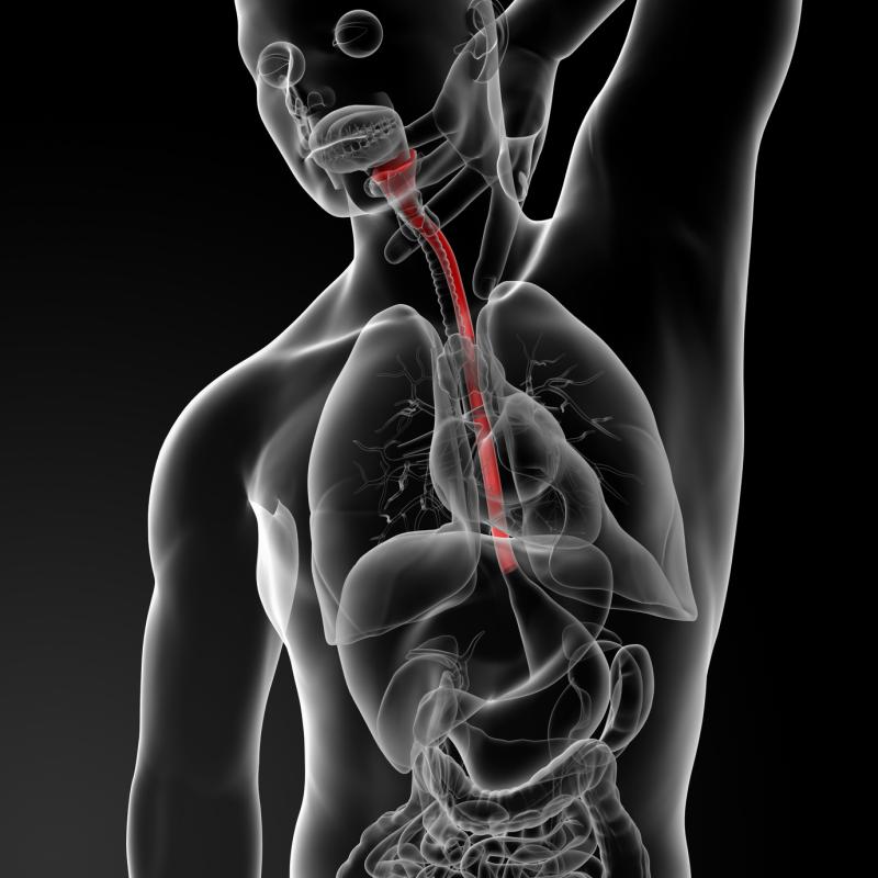 Achalasia linked to esophageal cancer risk