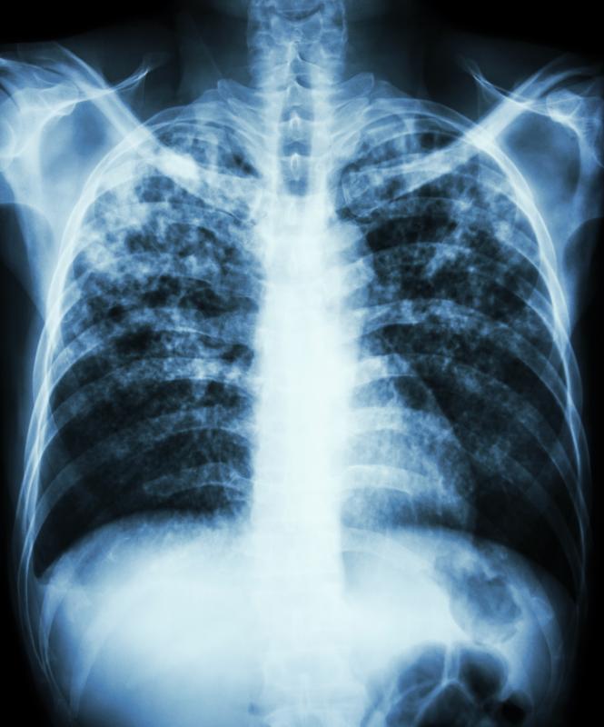 Tuberculosis in teens may be as severe as that in adults