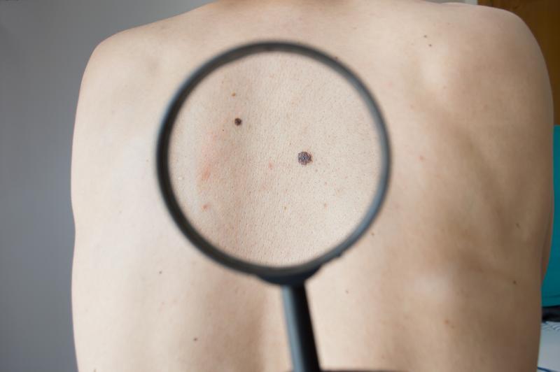 Multiple moles, genetic predisposition up risk of second primary melanomas