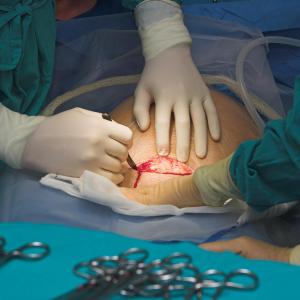 Difficult intubation rare in caesarean delivery under general anaesthesia in Singapore