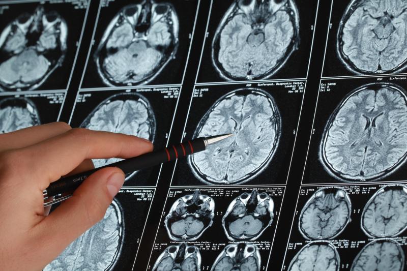 Veterans with higher traumatic brain injury predisposed to subsequent brain cancer