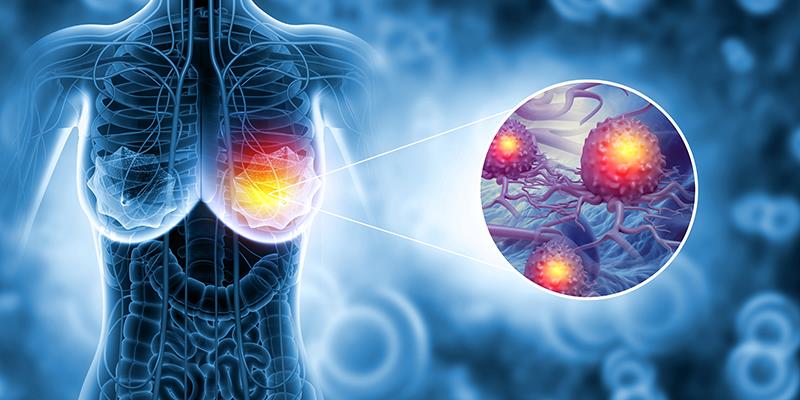 Abemaciclib extends survival in metastatic breast cancer