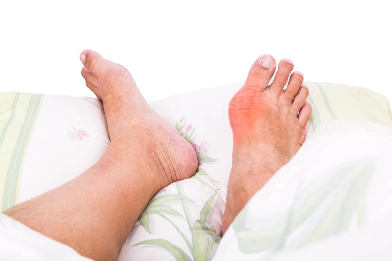 SGLT2 inhibitors a promising gout medication in T2D