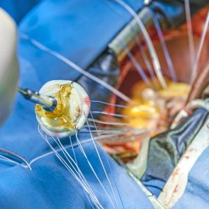 Valve-in-valve TAVR may replace surgical re-replacement in aortic bioprosthesis failure
