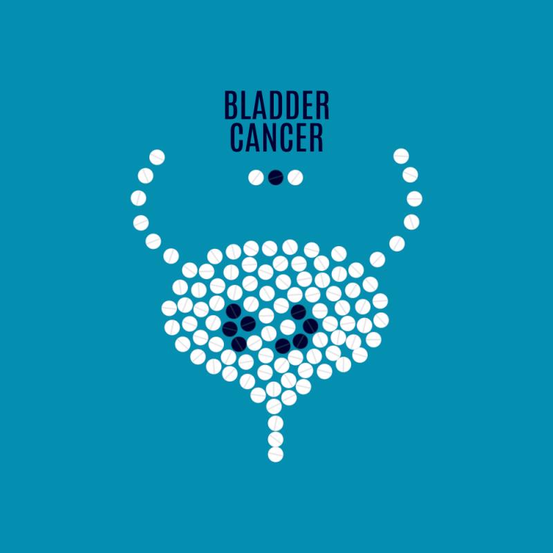 Use of maintenance immunotherapy as bladder-preserving therapy in node-positive muscle-invasive urothelial carcinoma