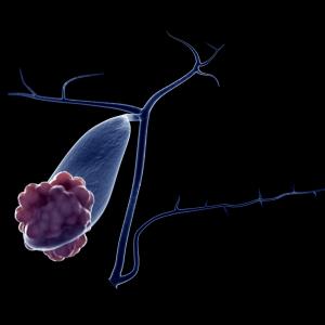 Irinotecan mono, doublet therapy: Similarly effective for gallbladder cancers?
