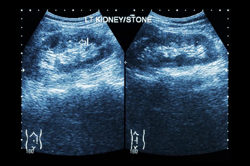 Flexible ureteroscopy slightly better than shock wave lithotripsy for paediatric renal stones