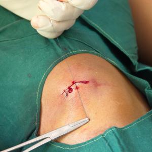 Subcuticular vs horizontal mattress suture: Which is preferable for wound closure?