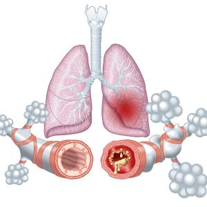 Lebrikizumab reduces asthma exacerbation in adolescents