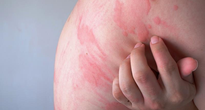 Does acupuncture work in chronic spontaneous urticaria?