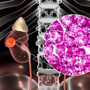 LITESPARK-005: Belzutifan sustains PFS, ORR benefits in advanced renal cell carcinoma