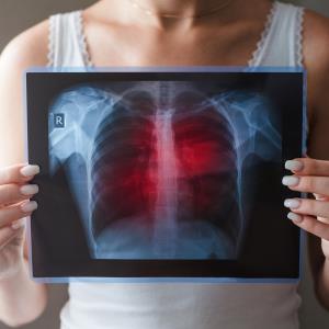 Many female lung cancer patients left out by screening criteria: study
