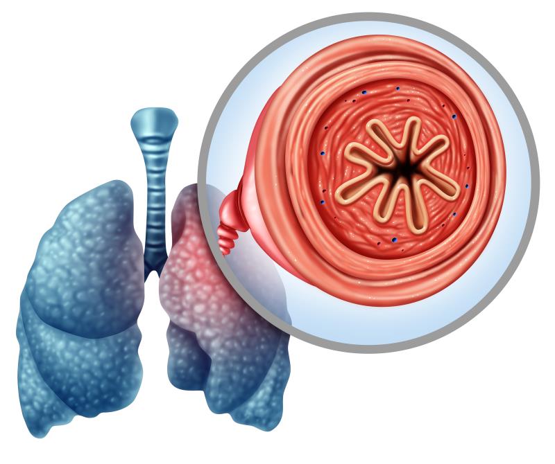 COPD associated with elevated risk of secondary spontaneous pneumothorax