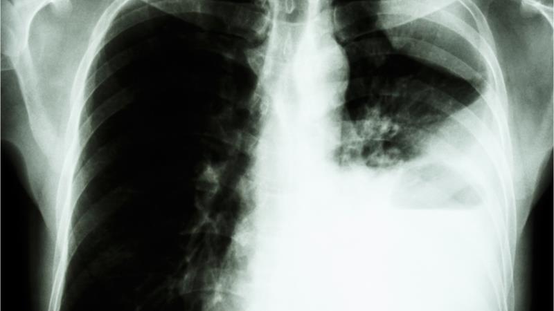 Dual inhibition of EGFR, VEGF improves progression-free survival in NSCLC