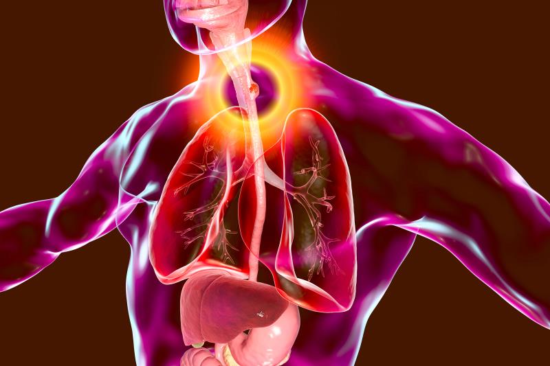 High- vs low-risk T1a EAC tied to more extraesophageal metastases