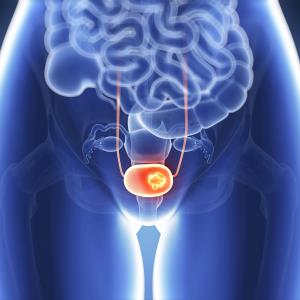 What’s new in advanced urothelial carcinoma?