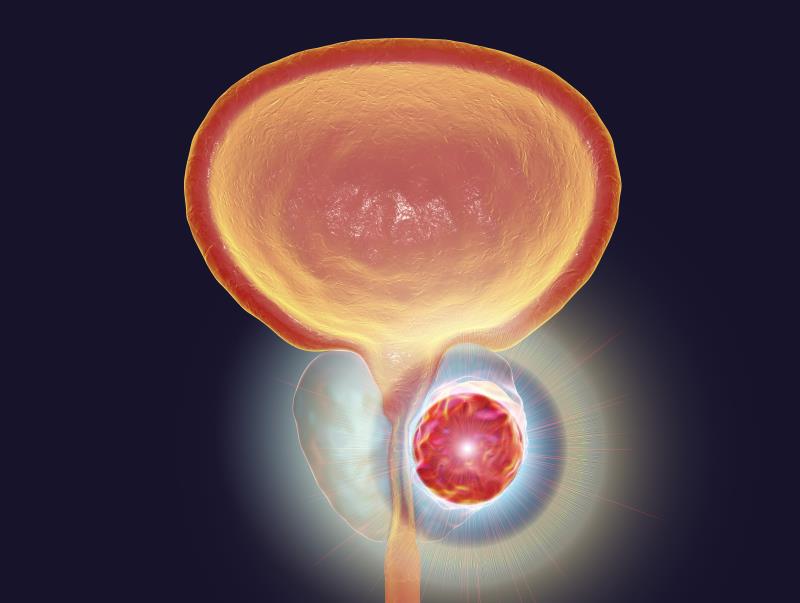 Optimizing metastatic hormone-sensitive prostate cancer treatment in advanced prostate cancer