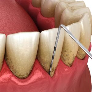 PPI use tied to less severe gum disease