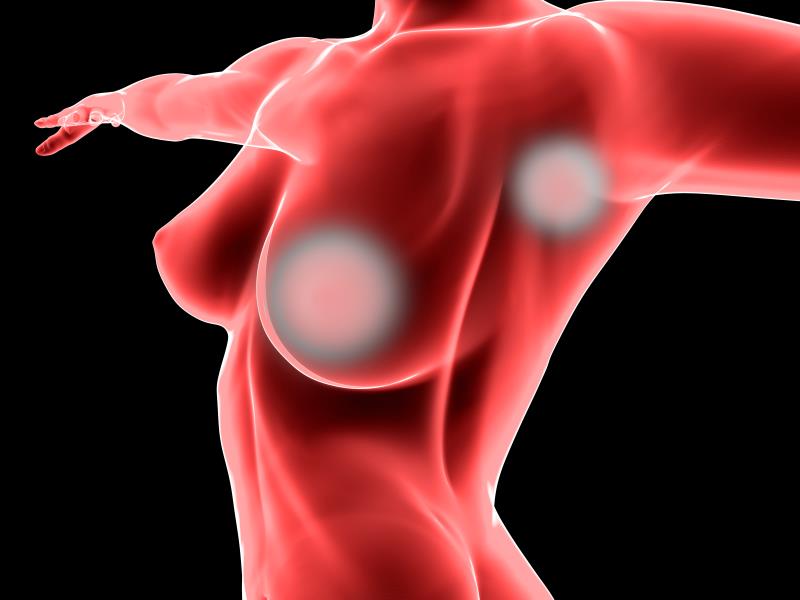 Risk of nonkeratinocyte skin cancers postradiotherapy high among breast cancer patients