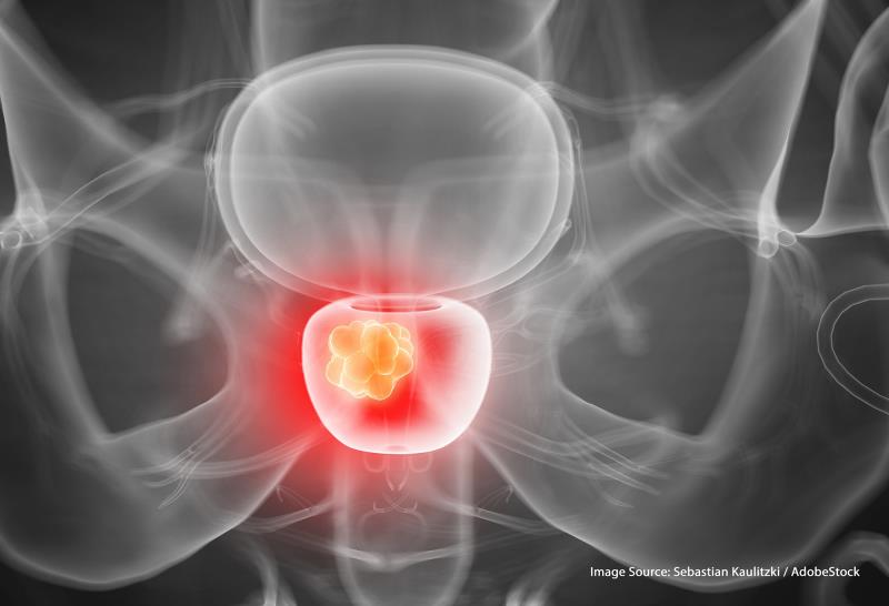 Focal therapy an effective option for older, comorbid prostate cancer patients