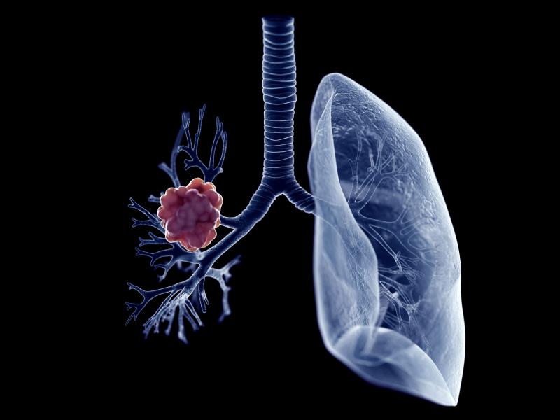Sunvozertinib shows promise in pretreated NSCLC with EGFR exon 20 insertions