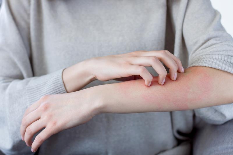 Gene profiling of skin lesions improves diagnosis of allergic contact dermatitis
