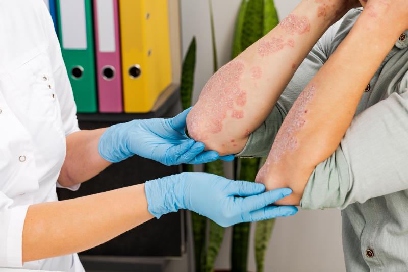Online on par with in-person care for improving outcomes in psoriasis